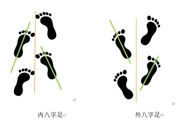 内,外八字足步态示意图.本文作者供图