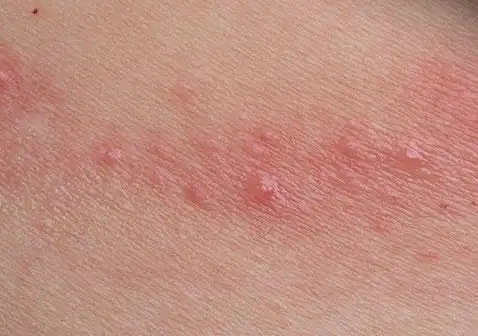 护肤品,洗衣粉等)会导致身上起红疙瘩越挠越痒的皮肤状况