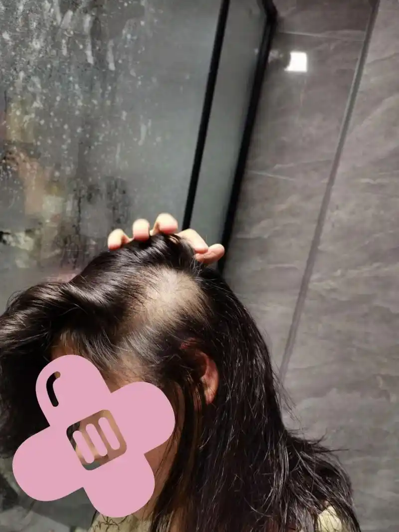 13岁女儿拔毛癖怎么办?