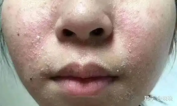 秋冬皮肤干起皮,怎么办? - 知乎