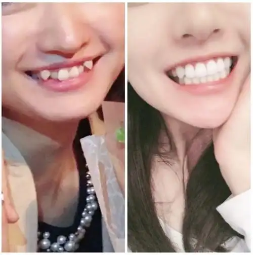 有虎牙要不要做牙齿矫正