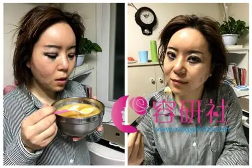 菲德姆术后护理师张娟自体脂肪全脸填充术后当天的消肿南瓜粥