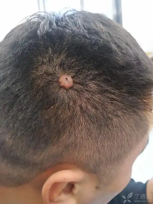 头上长了个瘤子十来年了