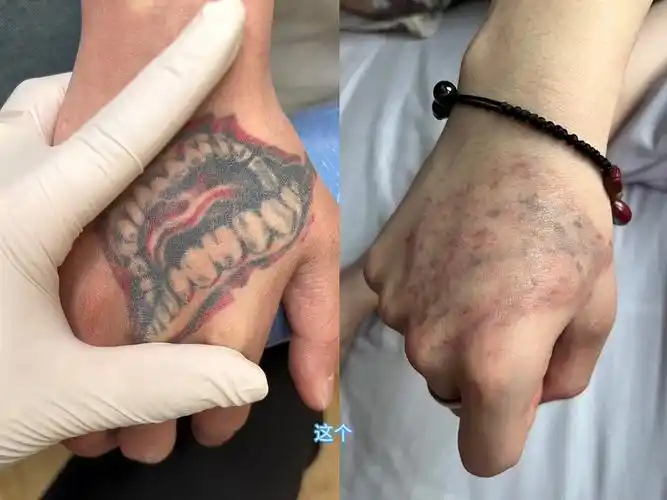 高难度虎口纹身清洗三次对比记录