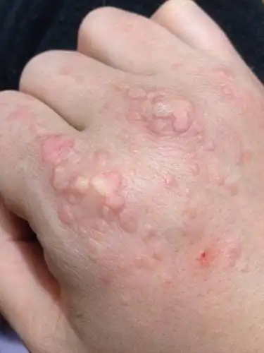 手上有很多瘊子,该怎么办