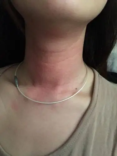 脖子的喉管处,皮肤很痒,外表无颗粒也无病变症状,痒了3天了,是奇