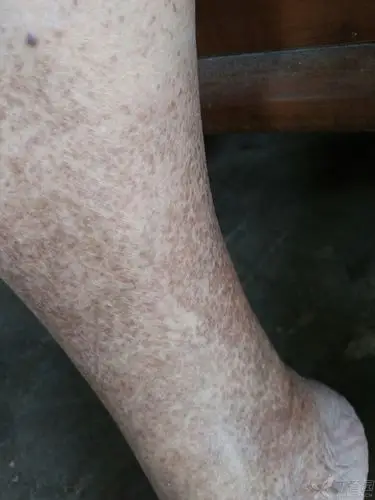痛不痒,不高出皮肤,双下肢对称性皮疹,请大家帮忙诊断一下这是什么病