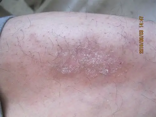 6.3典型下肢神经性皮炎