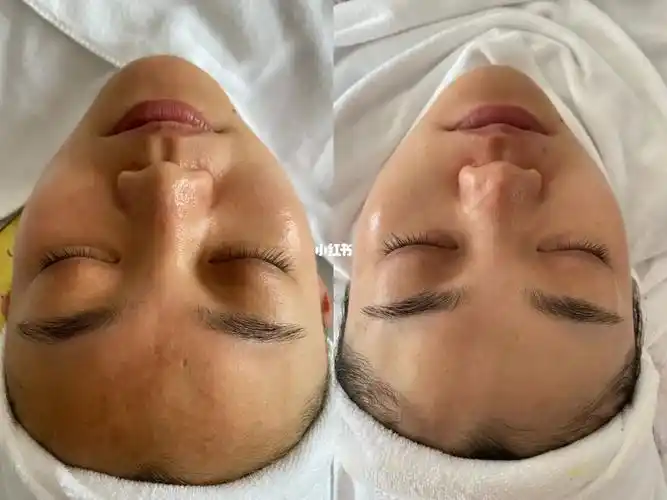 中药面膜治疗前后对比_中药面膜_夏天去哪玩_护肤_美妆_护肤_面膜