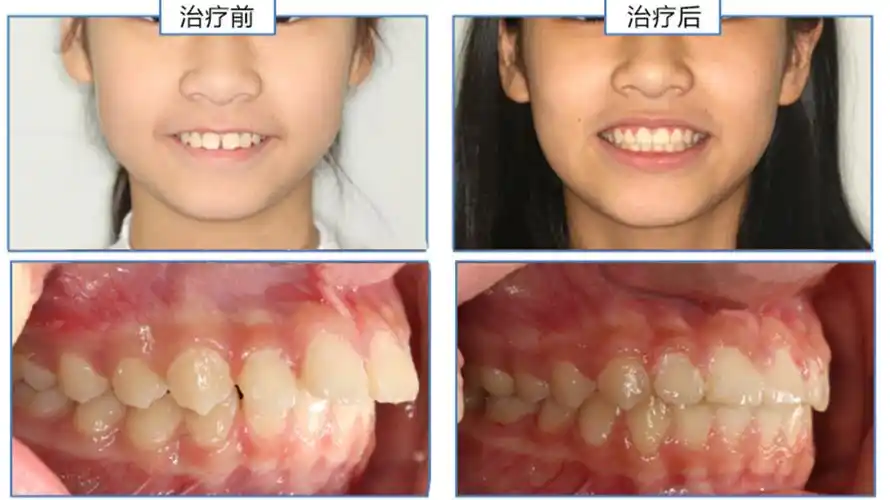 【儿童早期矫正案例】想改善暴牙的脸型,是不是一定要拔牙矫正?
