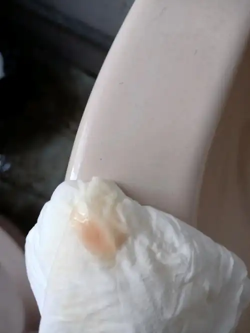 早上上厕所发现白带有血丝要去医院吗?