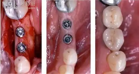 种植牙旁边的牙歪了怎么办问题不大不要慌