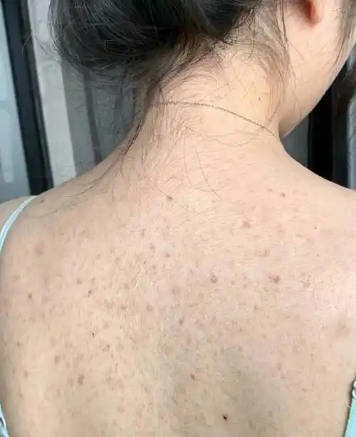 和后背痘说拜拜过来人手把手教你除螨祛痘重拾清爽自信