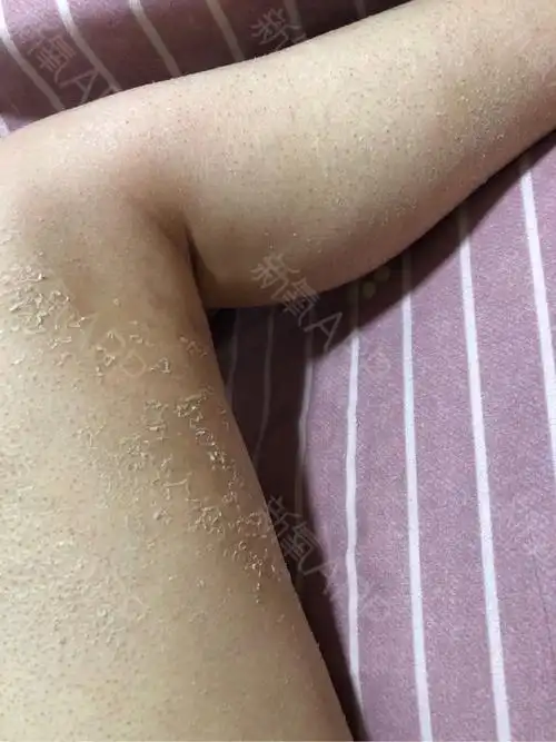 目前状态:腿围没有再变化,继续严重脱皮,皮肤粗糙;大腿