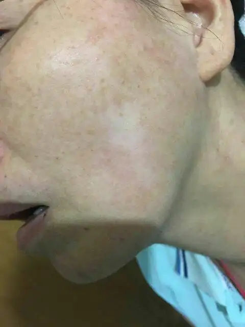脸上突然发现有块白的,这是什么病吗?如图