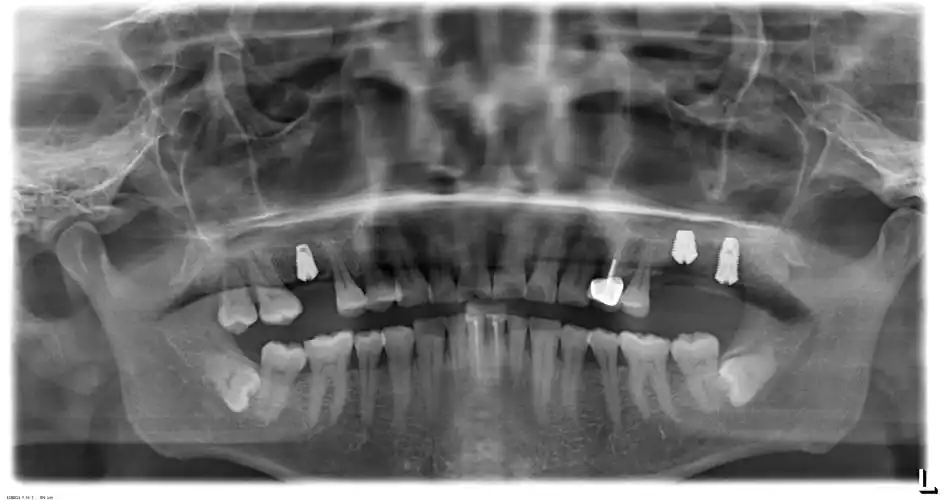 我的种植牙日记机械维修工程师的渡江口腔种植修复之路