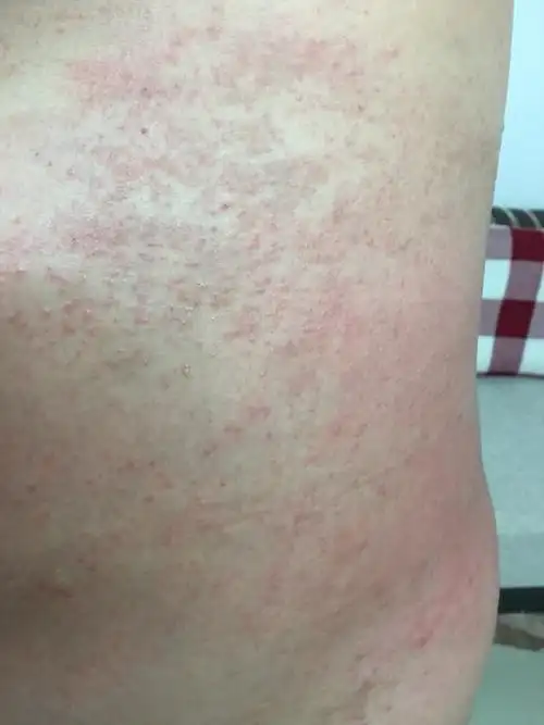 肚子起红疙瘩痒得崩溃