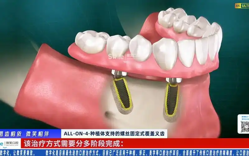 a1·all-on-4·种植体支持的螺丝固定式覆盖义齿_哔哩哔哩_bilibili