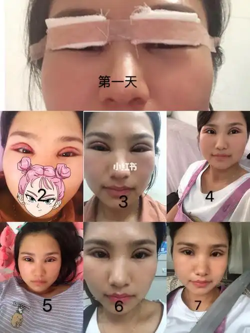 双眼皮术后17天对比图