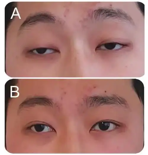 neurology容易误诊为重症肌无力的leigh综合征