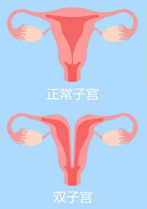 天生2个子宫她能生孩子吗