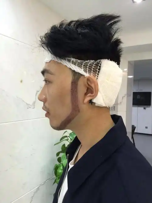 胡须种植有一年半了生长的很好非常自然不知道的朋友还_圈子-新氧美容