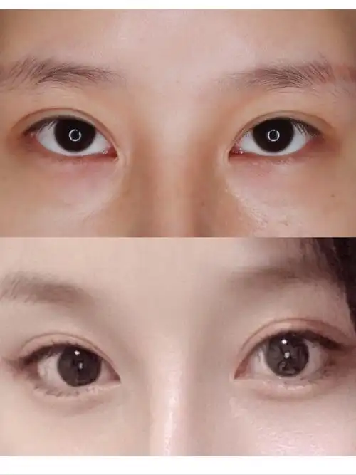 下睑下至外眼角合在一起的魔法就是