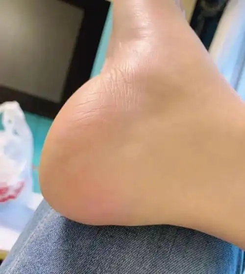 夏天脚后跟干裂起硬皮是什么原因怎么治,脚后起硬皮是什么原因怎么治