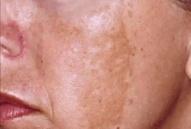 脸上的黄褐斑到底应该怎么办?看看中医是怎么治疗黄褐斑的_色素