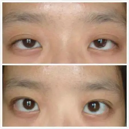 昆明bbh整形|上睑下垂|眼提肌无力矫正