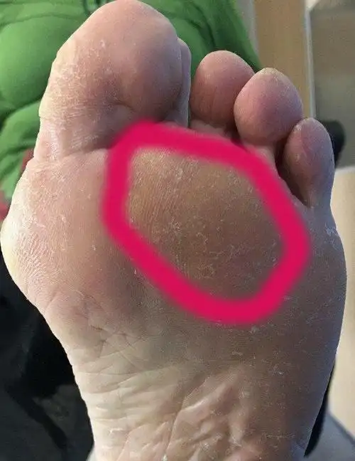 前脚掌疼痛_疼痛_介绍_缓解方法 - 好大夫在线