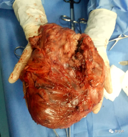 软组织肉瘤(sts)