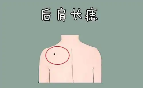 男人巨富痣男人巨富痣和大富痣在什么位置