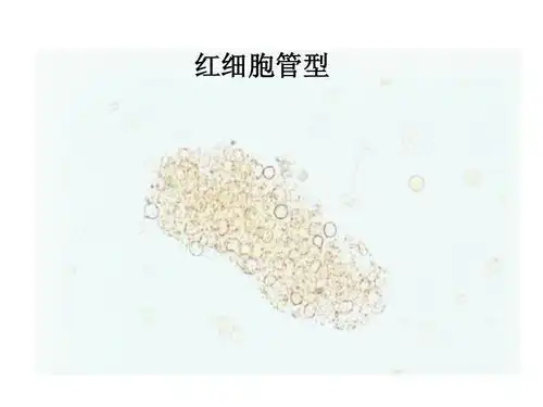 实验诊断学 红细胞管型
