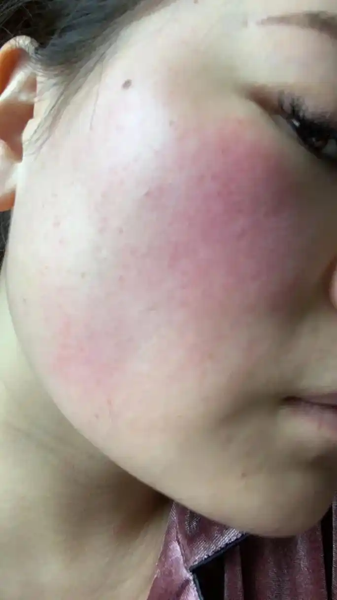 脸上皮肤容易过敏发红发烫的小姐姐们,一定要试试这个#告别肌肤 - 抖