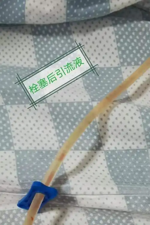 深圳首例!介入微创法成功治疗顽固性淋巴漏患者