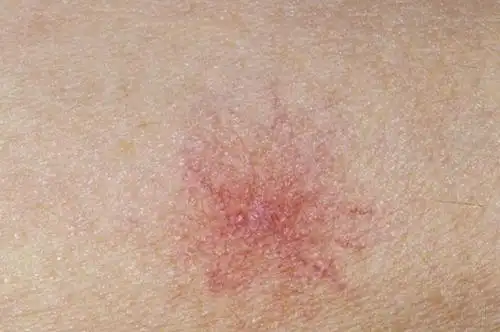 肝癌没征兆,发现即晚期?其实腿部会有"微提醒",千万别忽视了_孙力