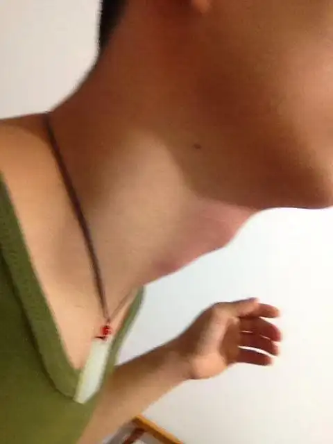 喉结很大,,,不知道是不是有什么病没有,求好人!