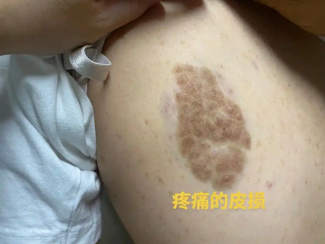 神经纤维瘤病1型,3千之一的发病率,家族性,基因缺陷.皮肤典 - 抖音