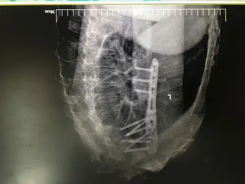 术后左肩x线侧位片
