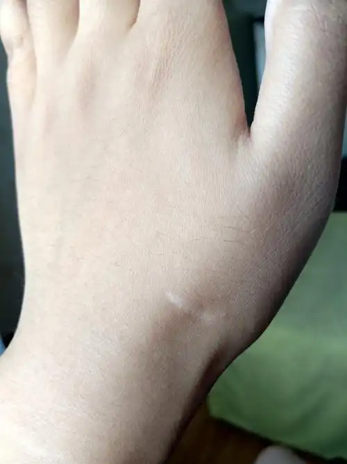手上这个疤痕难看吗?严重吗?