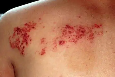 单纯疱疹病毒性睑皮炎