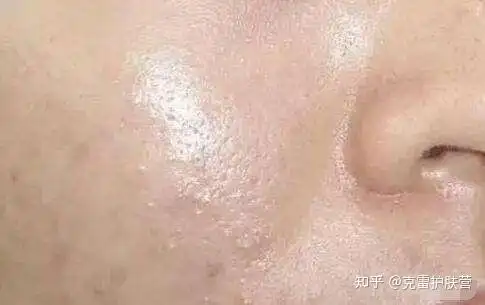 肤质可分为干性皮肤,中性皮肤,油性皮肤,敏感皮肤,混油皮肤,混干皮肤