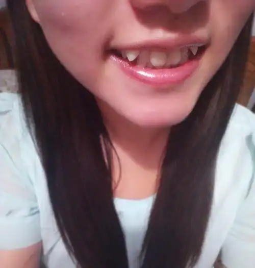 【图】小虎牙和牙齿不齐