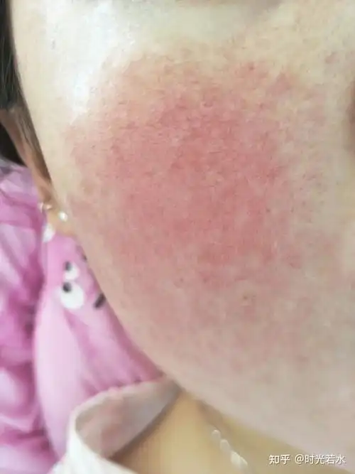 怎样判断自己是不是敏感肌脸过敏是怎么修复