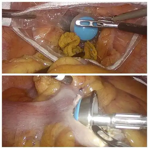双镜联合乙状结肠癌noses手术