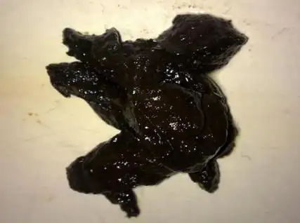 粉状,灰白色,无色或白色大便,又叫非正常婴儿大便可能是胆汁缺乏的