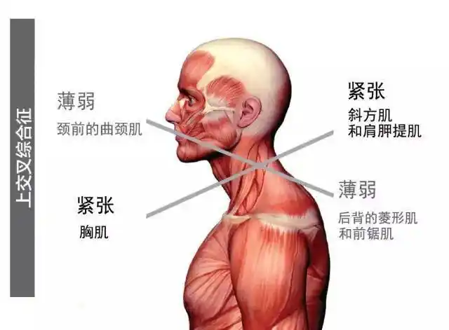 正面的胸肌和后面的斜方肌,肩胛提肌紧张:具体表现为:是身体正面与
