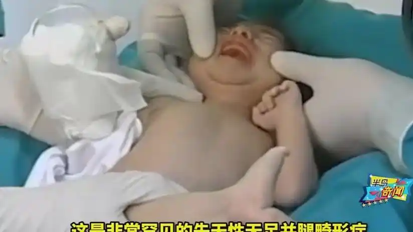 她是一条"美人鱼",3次手术后发生奇迹,如今健康成长