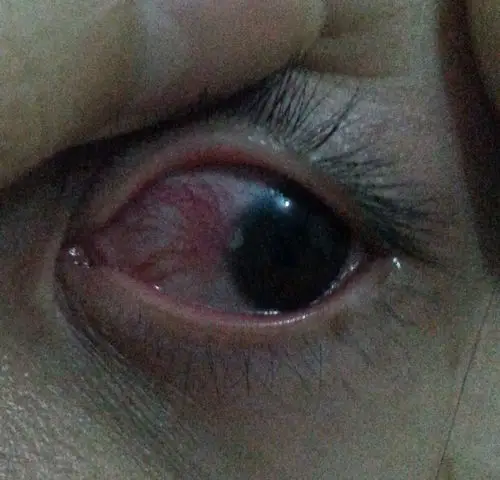 男友眼球上长了一个芝麻大的白色小痘痘,眼白还有红血丝,好可怕,是